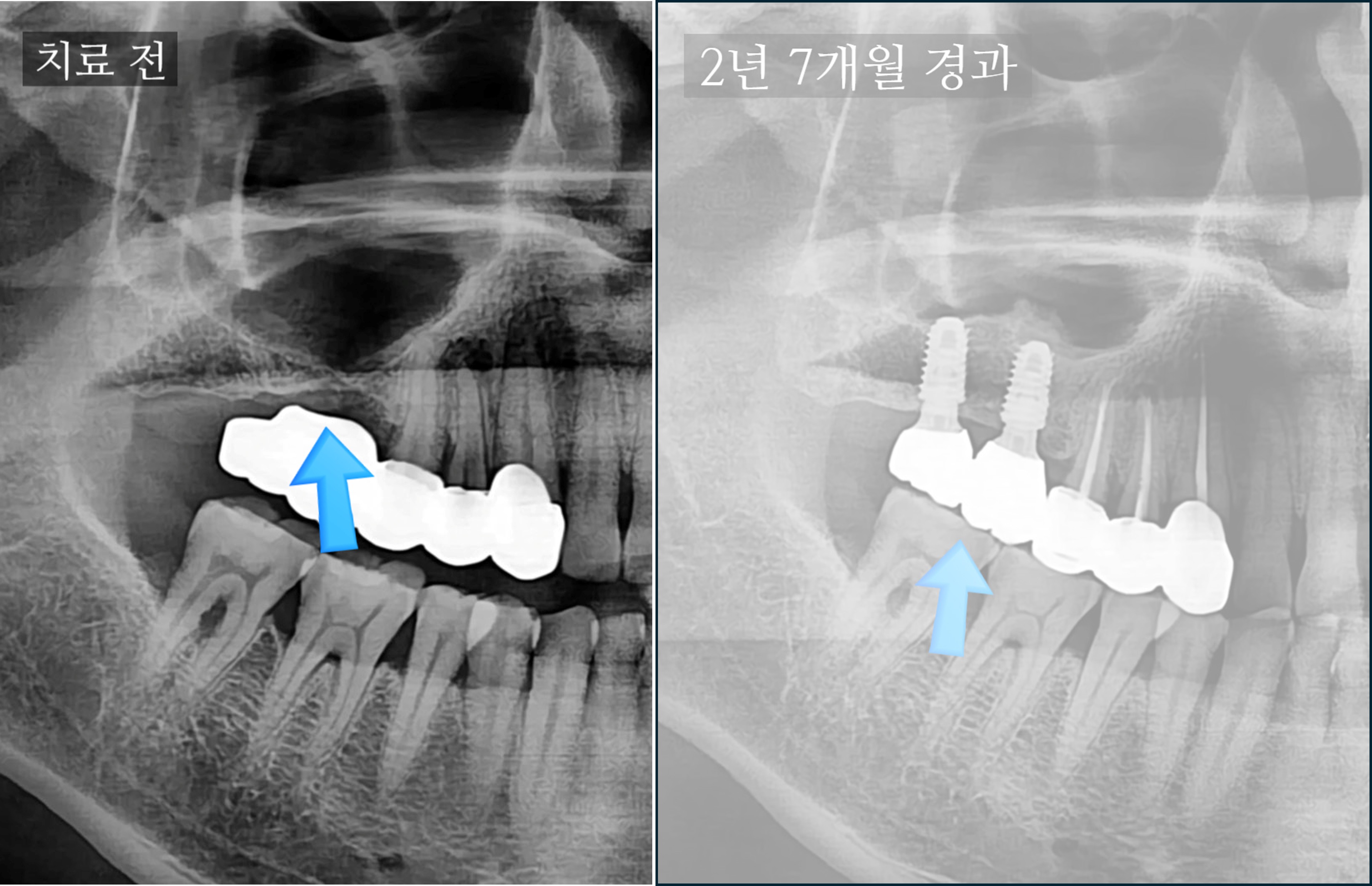 임플란트, 상악동 거상술